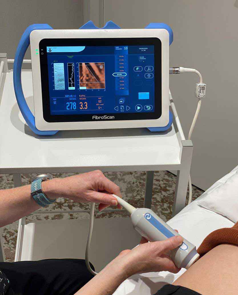 Fibroscan is a quick and painless diagnostic test used to measure liver damage (fibrosis) and fatty liver (steatosis).